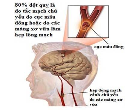 Rối loạn vận mạch não có thể diễn biến thành căn bệnh nghiêm trọng hơn không?
