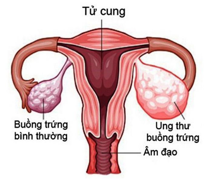 Các giai đoạn của ung thư tử cung và buồng trứng là gì?
