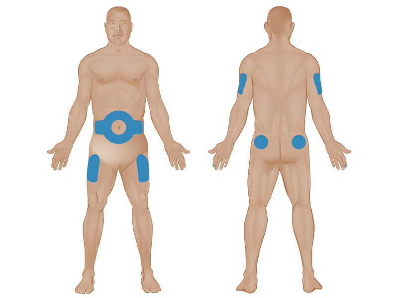 Tìm hiểu về kỹ thuật tiêm insulin dưới da và cách sử dụng đúng