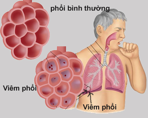 Có những phương pháp điều trị viêm phổi ở người lớn nào mới và hiệu quả?
