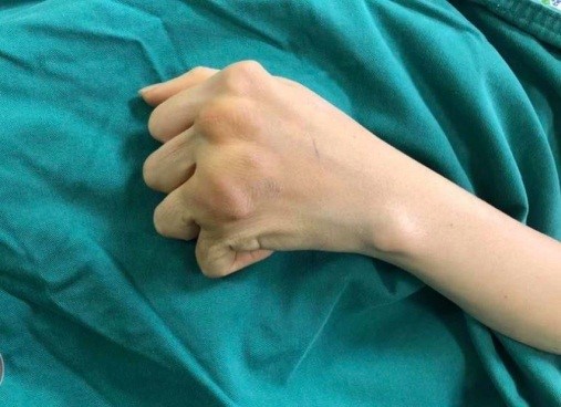 Bác sĩ chuyên khoa nào nên được thăm khám khi bị viêm khớp khuỷu tay?