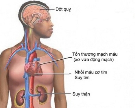 Người trên 60 tuổi bị huyết áp cao thường được điều trị bằng phương pháp nào?
