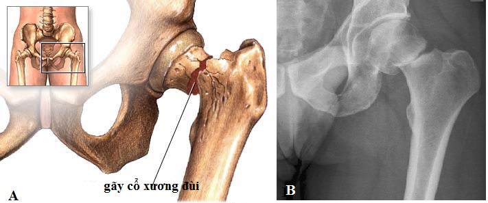 Cách chẩn đoán gãy khớp háng như thế nào?
