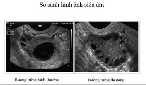 Đa nang buồng trứng: Nếu bạn đang tìm kiếm thông tin về đa nang buồng trứng và những vấn đề liên quan đến sức khỏe sinh sản của phụ nữ, hãy xem hình ảnh liên quan đến đề tài này. Bạn sẽ hiểu rõ hơn về tình trạng này và các biện pháp điều trị hiệu quả.